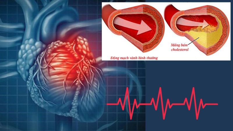 benh-tim-thieu-mau-cuc-bo-la-gi-3-800x450